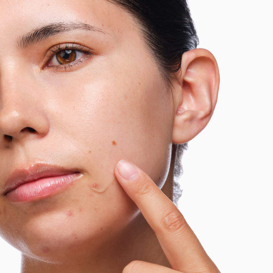 the-acne-set-c6 rdn-the-acne-set-application.png