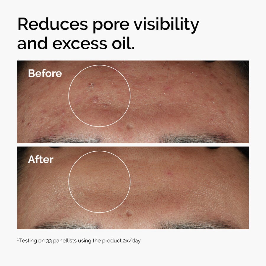 niacinamide-10-zinc-1-e0 ord-niacinamide-zinc-blemish-serum-before-after-pores.jpg
