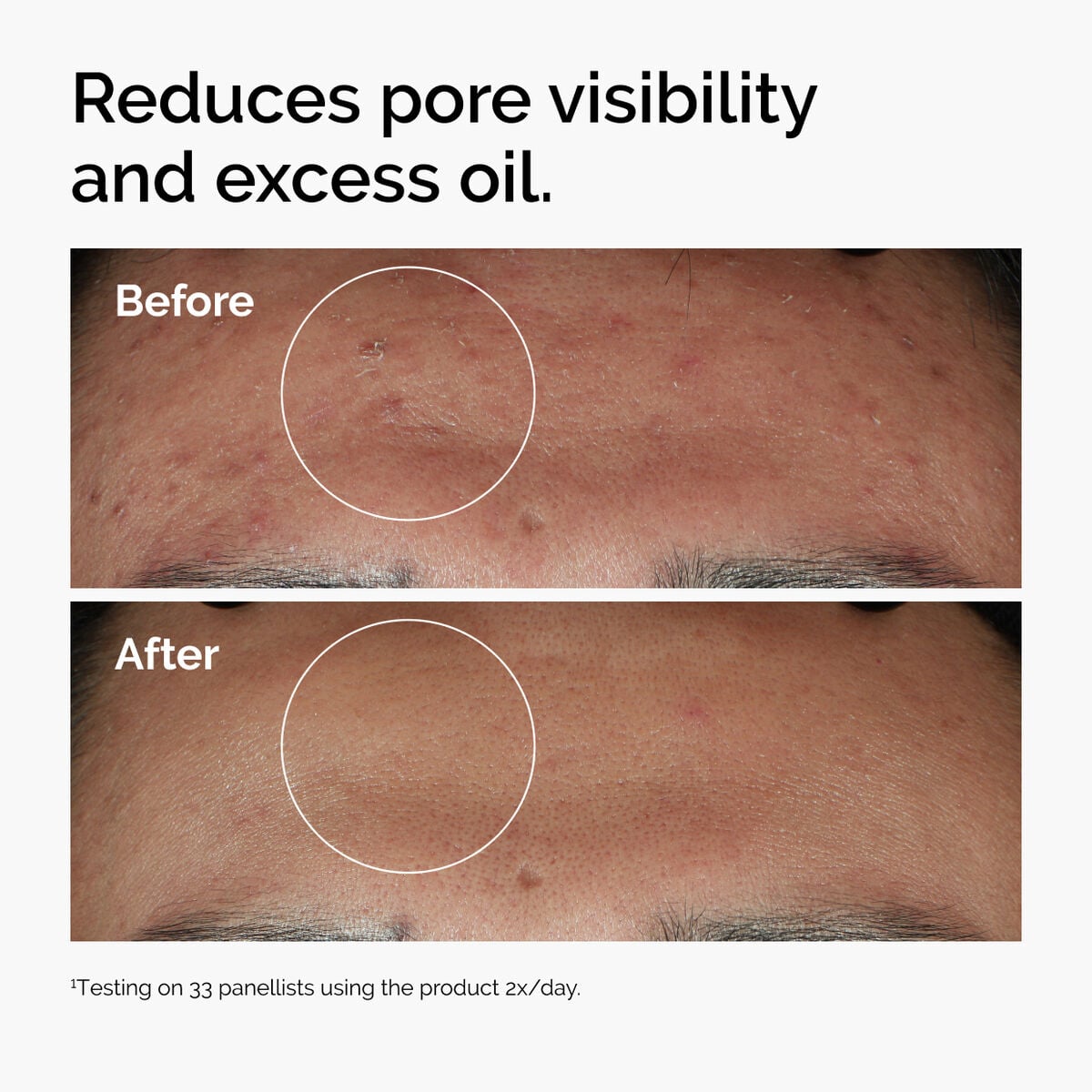 niacinamide-10-zinc-1-e0 ord-niacinamide-zinc-blemish-serum-before-after-pores.jpg