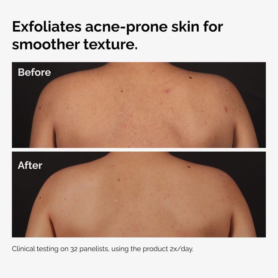 the-body-care-collection-m3 ord-salicylic-acid-body-serum-before-after-graphic-NA.jpg